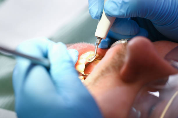 Best Emergency Root Canal Therapy in Clare, MI
